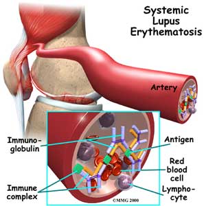 من أمراض المناعة الذاتية مرض الذئبة الحمراء SLE (2)